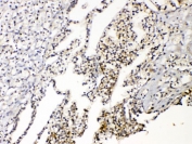 IHC-P: AQP3 antibody testing of human renal cancer tissue. HIER: Boil the paraffin sections in 10mM citrate buffer, pH6, for 20 mins.