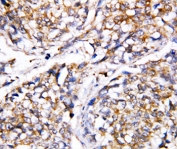 IHC-P: Caspase-4 antibody testing of human breast cancer tissue