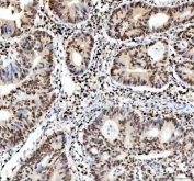 IHC staining of FFPE human colon adenocarcinoma tissue with APEX1 antibody. HIER: boil tissue sections in pH8 EDTA for 20 min and allow to cool before testing.