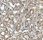 IHC staining of FFPE human prostate cancer tissue with APEX1 antibody. HIER: boil tissue sections in pH8 EDTA for 20 min and allow to cool before testing.