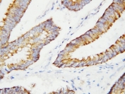 IHC-P: BCAT2 antibody testing of human colon cancer tissue