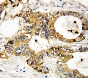 IHC-P: Annexin A3 antibody testing of human breast cancer tissue