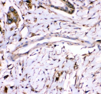IHC-P: Annexin A3 antibody testing of human breast canc