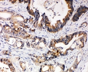 IHC-P: XIAP antibody testing of human intestinal cancer tissue