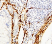 IHC-P: Caveolin-1 antibody testing of human breast cancer tissue