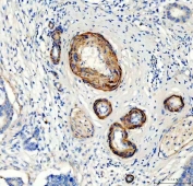IHC testing of FFPE human breast cancer tissue with Canstatin / Collagen IV antibody at 1ug/ml. Required HIER: steam section in pH8 EDTA buffer for 20 min and allow to cool prior to staining.