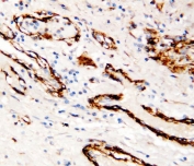 IHC testing of FFPE human breast cancer tissue with Canstatin / Collagen IV antibody at 1ug/ml. Required HIER: steam section in pH6 citrate buffer for 20 min and allow to cool prior to staining.