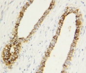 Caspase-1 antibody testing of human breast cancer tissue by IHC-P.