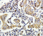 IHC-P: Caspase-8 antibody testing of human breast cancer tissue