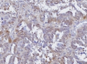 IHC staining of FFPE human ovarian adenoma tissue with BCAT1 antibody. HIER: boil tissue sections in pH8 EDTA for 20 min and allow to cool before testing.