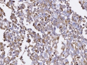 IHC staining of FFPE human pancreatic cancer tissue with BCAT1 antibody. HIER: boil tissue sections in pH8 EDTA for 20 min and allow to cool before testing.