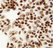 ICC staining of FFPE human HeLa cells with CTBP2 antibody. HIER: boil tissue sections in pH6 citrate buffer for 20 min and allow to cool before testing.