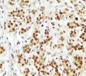 IHC staining of FFPE human breast cancer tissue with CTBP2 antibody. HIER: boil tissue sections in pH6 citrate buffer for 20 min and allow to cool before testing.