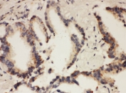 IHC testing of FFPE human lung cancer tissue with CUL1 antibody. (1)