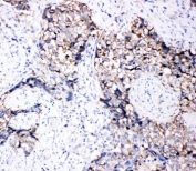 IHC-P: EphB3 antibody testing of human lung cancer tissue