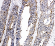 IHC-P: EphA1 antibody testing of human colon cancer tissue. HIER: steamed with pH6 citrate buffer.