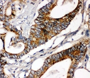IHC-P: Laminin gamma 1 antibody testing of human intestinal cancer tissue