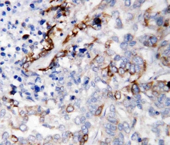 IHC staining of FFPE human lung cancer tissue with LAMC2 antibody. HIER: boil tissue sections in pH8 EDTA for 20 min and allow to cool before testing.~