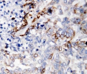 IHC staining of FFPE human lung cancer tissue with LAMC2 antibody. HIER: boil tissue sections in pH8 EDTA for 20 min and allow to cool before testing.