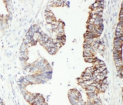 IHC-P: GST pi antibody testing of human intestinal cancer tissue.
