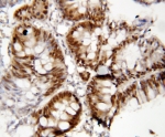 IHC-P: FOXP1 antibody testing of human rectal cancer tissue. HIER: steamed with pH6 citrate buffer.