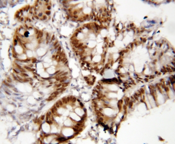 IHC-P: FOXP1 antibody testing of human rectal cancer tissue