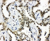 IHC-P: HDAC3 antibody testing of human lung cancer tissue.