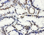 IHC-P: HDAC3 antibody testing of human intestinal cancer tissue.