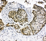 IHC-P: HOXA4 antibody testing of human breast cancer tissue. HIER: steamed with pH6 citrate buffer.
