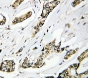 IHC-P: HSP105 antibody testing of human breast cancer tissue