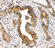 IHC-P: Integrin alpha 3 antibody testing of human intestinal cancer tissue. HIER: steamed with pH6 citrate buffer.