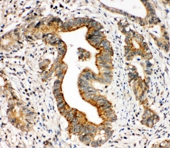 IHC-P: Integrin alpha 3 antibody testing of human intestinal cancer tissue