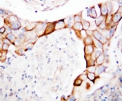 IHC-P: CD18 antibody testing of human breast cancer tissue. HIER: steamed with pH6 citrate buffer.