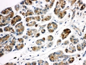 IHC-P: Kallikrein-1 antibody testing of human pancreatic cancer tissue