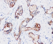 IHC-P: Kallikrein-2 antibody testing of human prostatic cancer tissue. HIER: boil tissue sections in pH8 EDTA for 20 min and allow to cool before testing.