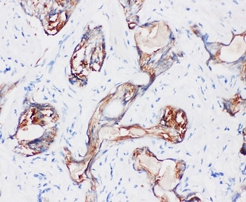 IHC-P: Kallikrein-2 antibody testing of human prostatic cancer tissue. HIER: boil tissue sect