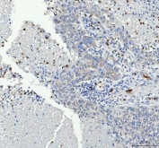 IHC staining of FFPE human liver cancer tissue with Integrin beta 3 antibody. HIER: boil tissue sections in pH8 EDTA for 20 min and allow to cool before testing.