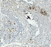 IHC staining of FFPE human laryngeal squamous cell carcinoma tissue with Integrin beta 3 antibody. HIER: boil tissue sections in pH8 EDTA for 20 min and allow to cool before testing.