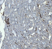 IHC staining of FFPE human thyroid cancer tissue with Integrin beta 3 antibody. HIER: boil tissue sections in pH8 EDTA for 20 min and allow to cool before testing.