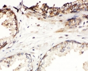 IHC-P: Kallikrein-11 antibody testing of human prostatic cancer tissue