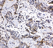 IHC-P: MRP1 antibody testing of human lung cancer tissue. Required HIER: steam section in pH6 citrate buffer for 20 min.