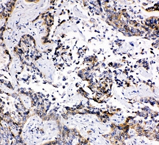 IHC-P: MRP1 antibody testing of human lung cancer tissue
