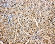 IHC-P: Kallistatin antibody testing of human liver cancer tissue