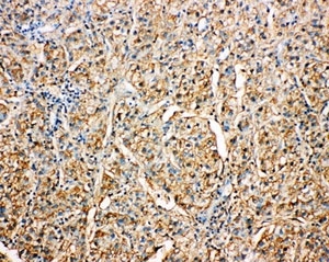 IHC-P: Kallistatin antibody testing of human liver cancer tissue