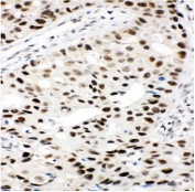 IHC staining of FFPE human breast cancer with Ku80 antibody. HIER: boil tissue sections in pH8 EDTA for 20 min and allow to cool before testing.