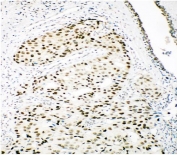 IHC staining of FFPE human breast cancer with Ku80 antibody. HIER: boil tissue sections in pH8 EDTA for 20 min and allow to cool before testing.