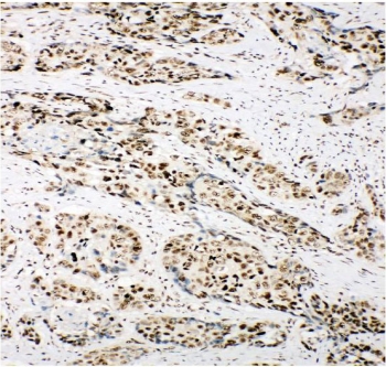 IHC staining of FFPE human lung cancer with Ku80 antibody. HIER: boil tissue sections in pH8 EDTA for 20 min and allow to cool before testing.