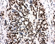 IHC-P: Ku80 antibody testing of human breast cancer tissue. HIER: boil tissue sections in pH6, 10mM citrate buffer, for 20 min and allow to cool before testing.