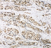 IHC staining of FFPE human lung cancer with Ku80 antibody. HIER: boil tissue sections in pH8 EDTA for 20 min and allow to cool before testing.