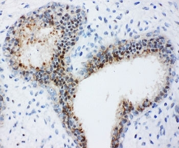 IHC-P: Bub3 antibody testing of human breast cancer tissue